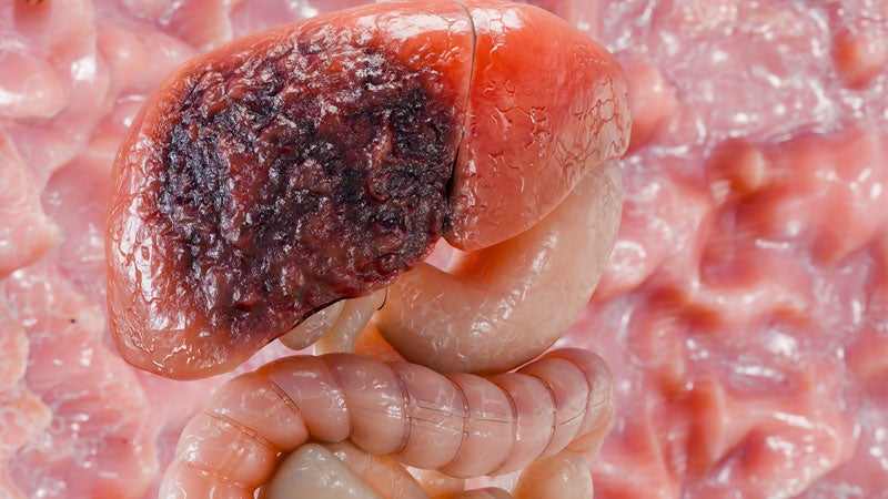 Hepatocellular Carcinoma