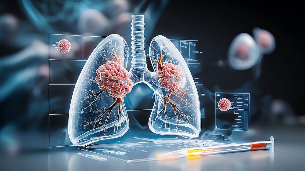 Lung cancer