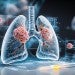 Lung cancer